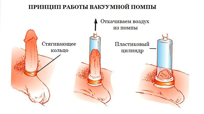 Как работает помпа для пениса? Улучшает ли она эрекцию и увеличивает ли пенис?